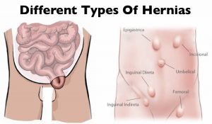 انواع فتق (Hernia) و روش های درمانی آنها | کافه پزشکی