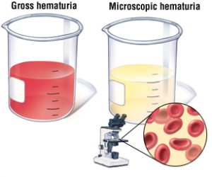 هماچوری (Hematuria)  یا وجود خون در ادرار ؛ چه عواملی باعث ایجاد این وضعیت می شود ؟ | کافه پزشکی