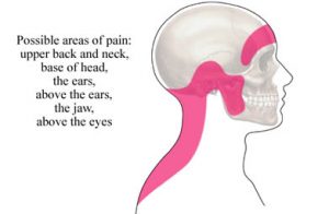 سردرد تنشی (Tension Headache) چگونه ایجاد می شود و چه درمانی دارد ؟ | کافه پزشکی