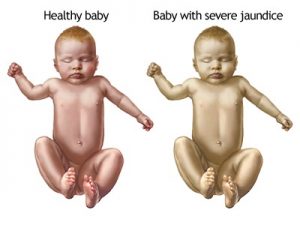 همه چیز درباره زردی نوزاد (Newborn Jaundice) ؛ علائم، علل و درمان آن | کافه پزشکی