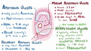 آفت دهان Aphthous Stomatitis چگونه ایجاد می شود و درمان آن چیست ؟ | کافه پزشکی