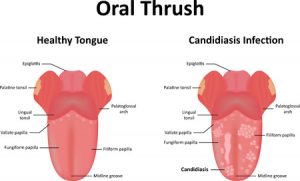 برفک دهان (Oral thrush) چگونه ایجاد می شود و درمان آن چیست ؟ | کافه پزشکی