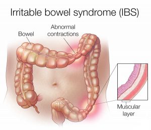 همه چیز درباره سندروم روده تحریک پذیر (IBS) | کافه پزشکی