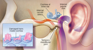 دلایل وزوز گوش (Tinnitus) چیست و چگونه آن را درمان کنیم ؟ | کافه پزشکی