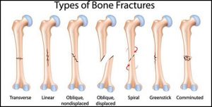 شکستگی استخوان ؛ انواع، علائم، تشخیص و درمان | کافه پزشکی