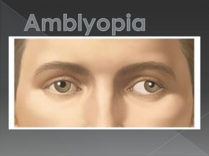 تنبلی چشم (آمبلیوپیا) ؛ علائم ، تشخیص و درمان | کافه پزشکی