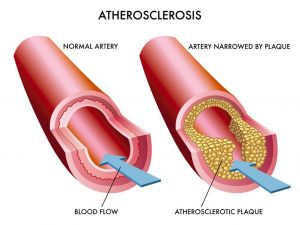 آترواسکلروزیس یا تصلب شرائین چیست و چگونه درمان می شود ؟ | کافه پزشکی