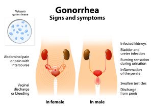 همه چیز درباره بیماری سوزاک (Gonorrhea) | کافه پزشکی