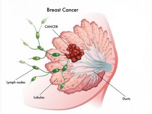همه چیز درباره سرطان سینه (Breast cancer) | کافه پزشکی