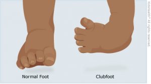 پای چنبری یا کلاب فوت Club foot چیست ؟ | کافه پزشکی
