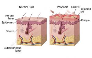 بیماری پسوریازیس Psoriasis ؛ تکه های برجسته و قرمز رنگ بر روی پوست | کافه پزشکی