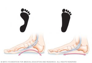 هر آنچه که در مورد صافی کف پا Flat Feet باید بدانید | کافه پزشکی