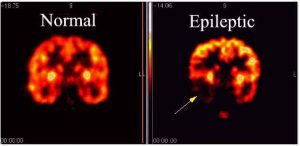 همه چیز درباره بیماری صرع (Epilepsy) ؛ چهارمین بیماری شایع عصبی در جهان | کافه پزشکی