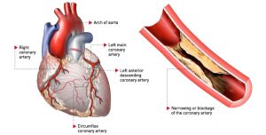 بیماری شریان کرونری یا CAD ؛ همه چیز درباره خطرناک ترین بیماری قلبی عروقی جهان | کافه پزشکی