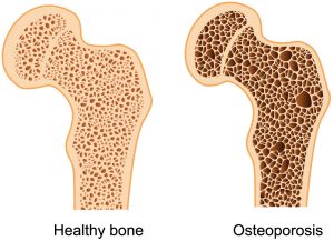 پوکی استخوان چیست و چگونه آن را درمان کنیم ؟ | کافه پزشکی