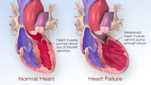 همه چیز درباره نارسایی قلبی Heart failure | کافه پزشکی