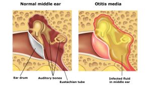 عفونت گوش میانی یا اوتیت مدیا Otitis media چیست ؟ | کافه پزشکی