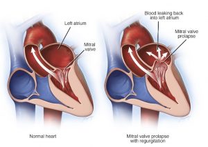 افتادگی دریچه میترال Mitral valve prolapse چگونه اتفاق می افتد و درمان آن چیست ؟ | کافه پزشکی