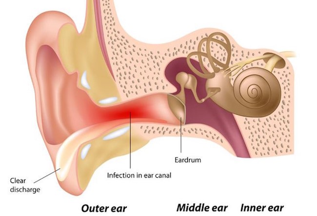 عفونت گوش خارجی