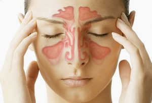 همه نکاتی که باید درباره سینوزیت Sinusitis بدانید | کافه پزشکی