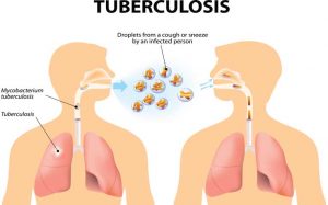 همه چیز درباره بیماری سل ( Tuberculosis) | کافه پزشکی