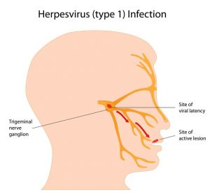 همه چیز درباره ویروس هرپس سیمپلکس ؛ عامل ایجاد تبخال دهانی و تناسلی | کافه پزشکی