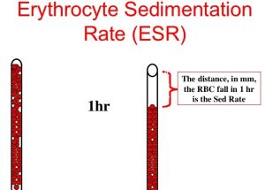 آزمایش خون : میزان سدیمانتاسیون اریتروسیت ها ESR | کافه پزشکی