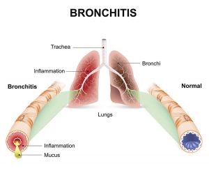همه چیز درباره بیماری برونشیت (Bronchitis) | کافه پزشکی