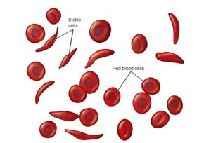 آزمایش خون : پدیده داسی شكل شدن گلبولها | کافه پزشکی