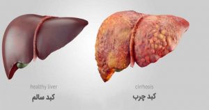 همه چیز درباره کبد چرب (Fatty Liver) ؛ علائم، علل و درمان آن | کافه پزشکی