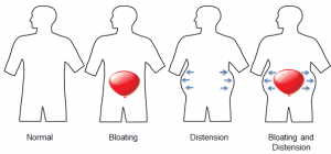 نفخ شکمی (bloating) چیست ؟ علل ایجاد کننده و درمان آن | کافه پزشکی