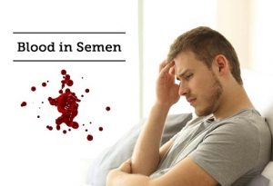 علت وجود خون در مایع منی (هماتو اسپرمیا) چیست؟ + علائم و درمان | کافه پزشکی