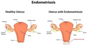 هر آنچه که باید در مورد بیماری آندومتریوز (Endometriosis) در زنان بدانید | کافه پزشکی