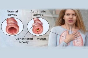 آسم چیست ؟ علل و عوامل تشدید کننده آن | کافه پزشکی