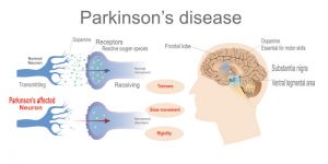 بیماری پارکینسون ؛ علائم ، علل و ریسک فاکتور های آن | کافه پزشکی