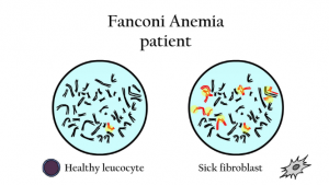 آنمی فانکونی ؛ علائم ، تشخیص و درمان | کافه پزشکی