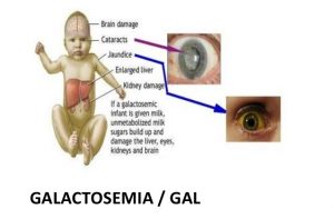 بیماری گالاکتوزمی ؛ علائم ، تشخیص و درمان | کافه پزشکی
