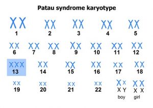 سندروم پاتو (تریزومی ۱۳) ؛ علائم ، تشخیص و درمان | کافه پزشکی