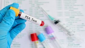 همه چیز درباره آزمایش پروستات PSA | کافه پزشکی