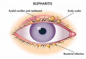 بیماری بلفاریت یا التهاب پلک ها؛ علائم، علل و درمان | کافه پزشکی