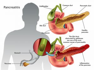بیماری پانکراتیت یا التهاب پانکراس ؛ علائم، علل و درمان | کافه پزشکی
