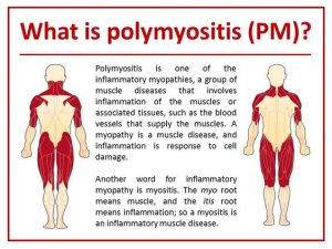 صفر تا صد بیماری پلی میوزیت (Polymyositis) | کافه پزشکی