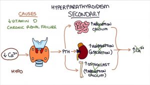 پرکاری پاراتیروئید یا هایپرپاراتیروئیدیسم چیست ؟ | کافه پزشکی