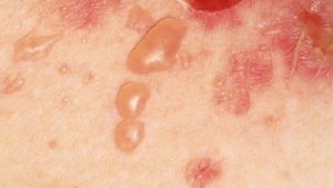 بیماری پمفیگوس ؛ ایجاد تاول و زخم در پوست یا غشاهای مخاطی | کافه پزشکی
