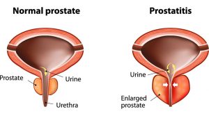 بیماری پروستاتیت یا التهاب و عفونت پروستات ؛ علائم، علل و درمان | کافه پزشکی