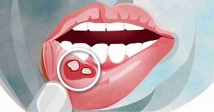 بیماری استوماتیت یا التهاب فراگیر دهان ؛ علائم، علل و درمان | کافه پزشکی