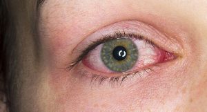 همه چیز درباره بیماری یوئیت یا التهاب لایه میانی چشم | کافه پزشکی