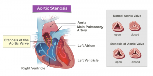 همه چیز درباره تنگی دریچه آئورت (Aortic valve stenosis) | کافه پزشکی