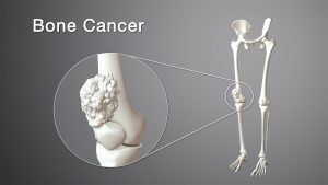 سرطان استخوان