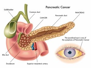 سیر تا پیاز سرطان پانکراس یا لوزالمعده ؛ عامل ۳ درصد از تمام سرطان ها | کافه پزشکی